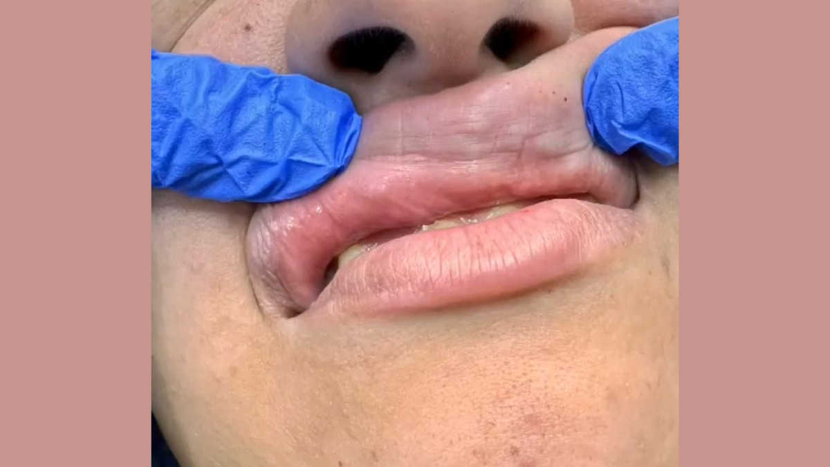 Filler dissolving in Hurghada